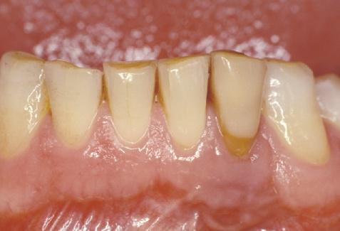 In den 1970er Jahren wurden auf diese Weise erstmals künstliche Zähne mittels Säureätztechnik und den inzwischen vorhandenen Kompositkunststoffen an angrenzenden Pfeilerzähnen befestigt 34.