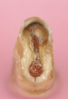 1-5 Ansicht des entfernten Zahns von basal mit unbehandeltem lingualen Wurzelkanal und Riss in der