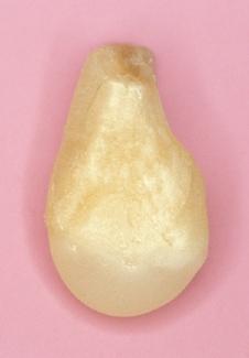 1-6 Umformung des basalen Zahnanteils mittels Adhäsivtechnik und Kompositkunststoff in eine eiförmige