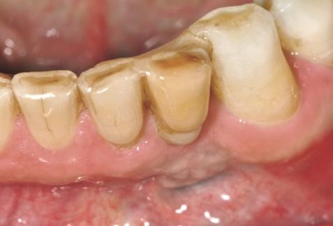 Dieser Fall ist ein Beispiel für die gute Dauerhaftigkeit von Verklebungen am Zahnschmelz.
