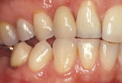 der Pfeilerzähne kommt es immer zu minimalen, aber häufig unterschiedlich gerichteten Zahnbewegungen.