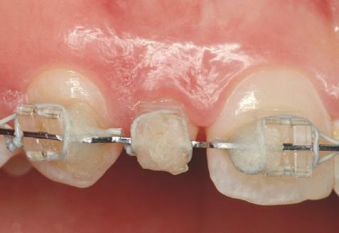 Da die supragingivalen Restaurationsränder Plaque-Retentionsstellen darstellen, können Adhäsivbrücken nur bei adäquater Mundhygiene langfristig erfolgreich sein.