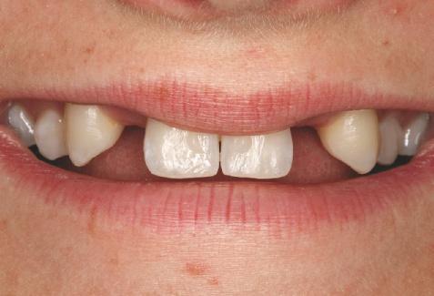 Kapitel 10 Vollkeramische Adhäsivbrücken detailliert Abb. 10-5 Lippenbild. Die Patientin entblößt die Gingiva beim Lachen nicht. Abb. 10-6 Labialansicht mit retrahierten Lippen.