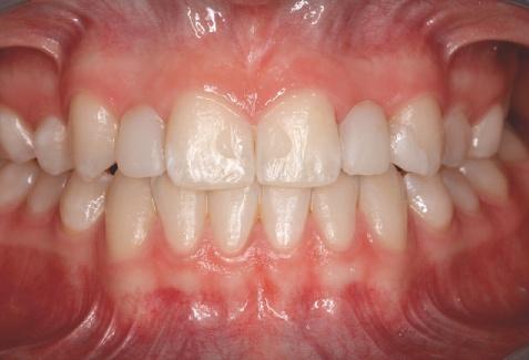 10-8 Lippenbild mit eingesetztem Mock-up. Eine Weichgewebeaugmentation im Bereich der fehlenden Zähne erscheint unnötig.