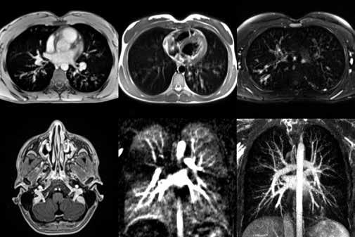 Forschungshighlight im Bereich Klinischer Bildgebung 2019 Präzise und strahlenfrei Die wachsende Bedeutung der Magnetresonanztomografie bei der Erforschung und Therapie von Lungenkrankheiten