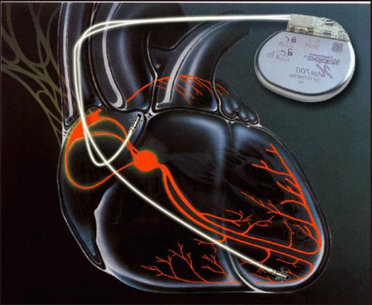 Wie arbeiten Herzschrittmacher und Co?