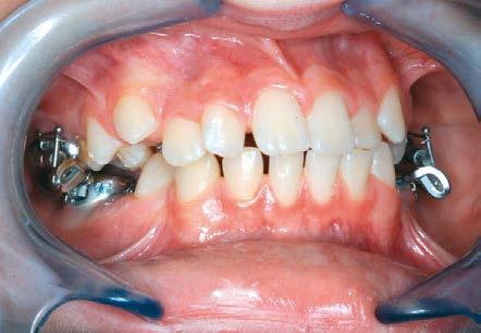 lateralen Zahnbogen geklebt werden. Am häufigsten kommen frontale Aufbisse bei Tiefbiss- Patienten zur Anwendung.