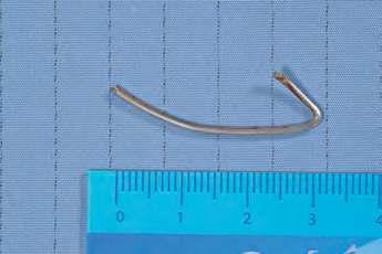 Mein kuriosester Fund im Auge eines Patienten waren kleine Fischzähne, nachdem der Betroffene in Thailand von einem Fisch gebissen worden