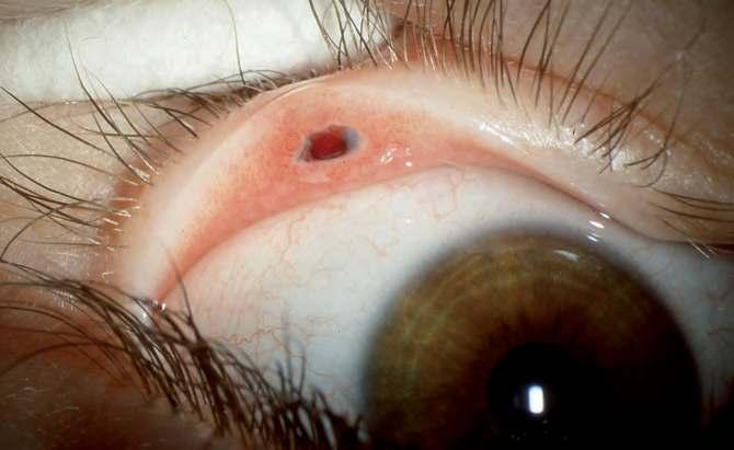 3 Wenn s das Auge trifft Augenverletzungen Subtarsaler Fremdkörper tionen und Geschwüre entwickeln können, auszuschließen.