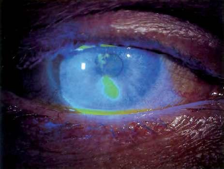 3 Wenn s das Auge trifft Augenverletzungen Mir hat etwas das Auge zerkratzt Fluoreszein Trotz unseres raschen Lidreflexes kann es passieren, dass Gegenstände mit der Augenoberfläche in Berührung