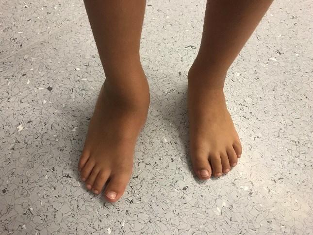 1. Einleitung Der Knick-Senkfuß (pes planovalgus) ist eine komplexe und häufige Fehlstellung des Fußes im Kindes- und Erwachsenenalter.
