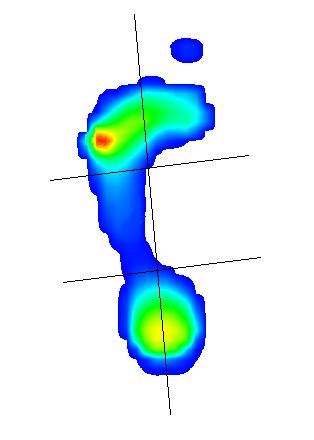 Abbildung 10: Unterteilungsmuster des Fußes bei der Pedobarografie in 6 Kompartimente Dabei zeigte sich präoperativ eine prozentuale Belastung der medialen Fußhälfte von ca.