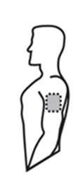 - Wählen Sie einen Bereich nicht gereizter, intakter Haut an der Außenseite des Oberarmes, am oberen Brustkorb, oberen Rücken oder seitlich am Brustkorb (siehe nebenstehende Abbildungen).