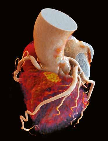 Aufbau und Funktion des Herzens Darstellung eines Herzens mit syngo.via Cinematic VRT. syngo.via Cinematic VRT ermöglicht es, fotorealistische Bilder von Organen wie aus einem Anatomie-Handbuch zu erstellen.