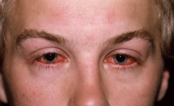 Welche Untersuchungen gibt es? Die meisten Ärztinnen und Ärzte untersuchen zuerst das äußere Auge. Die Anzeichen einer Bindehaut-Entzündung sind gut erkennbar.