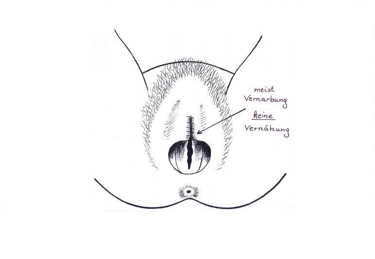 Abbildung 2: Klitoridektomie oder modifizierte Sunna 7 Die Exzision: Damit bezeichnet man die teilweise oder vollständige Amputation der Klitoris einschließlich der teilweise oder vollständigen