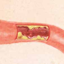 Dies kann folgende Konsequenzen haben: n Die Wände der Arterie werden dicker und rauer. n Die Plaqueablagerungen behindern den Blutfluss durch die Arterie.