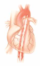 Die Therapie mit einer intraaortalen Ballonpumpe hilft dabei, das Gleichgewicht zwischen Angebot und Nachfrage des Sauerstoffs wiederherzustellen, das das Herz und die anderen Organe für ihre Arbeit