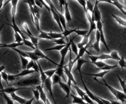 Atypische Zellen Im Folgenden eine Untergliederung nach Ursprungsgewebe: - Karzinom ist ein bösartiger Tumor, der seinen Ursprung in Epithelzellen hat (Zellen im Deckgewebe von Haut oder Schleimhaut