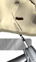 All-on-4 Klinische Verfahren bei zahnlosen Oberkiefern Schritt für Schritt Wenn Sie eine All-on-4 Behandlung des Oberkiefers vornehmen möchten, sollten Sie bei den posterioren Implantatbetten neben