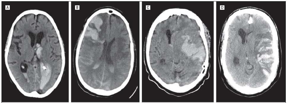 Thrombolyse unter Antikoagulation