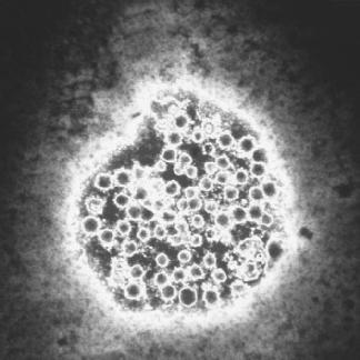 chronisch selten akut Viruspersistenz: ~ 75-80% der Infektionen HAV-RNA HBV-DNA