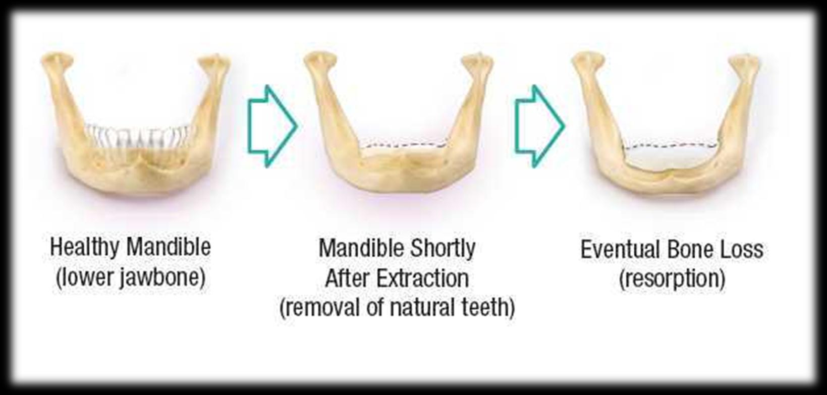 Probleme beim Tragen von Zahnprothesen Gesunder Unterkiefer Unterkiefer kurz nach dem