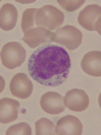 Typische Lymphozyten Large granular Lymphocyte LGL-Zellen Größe: 10 15 µm Kern: rund - oval leicht kondensiertes Chromatin Zytoplasma: mittelbreiter
