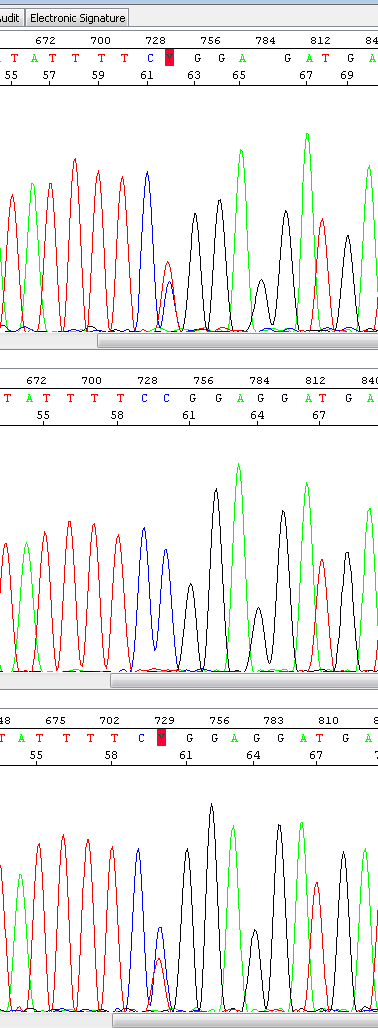 Beispiel Polkörperdiagnostik und Blastozystendiagnostik Meiose 1 CFTR: p.r334q, c.1001g>a rev. p.r334q, c.1001g>a 1.