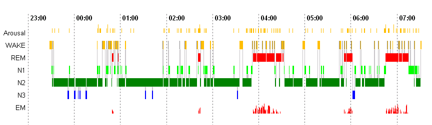 Polysomnographisches Profil eines guten Schläfers (oben) und eines Patienten mit Insomnie (unten)