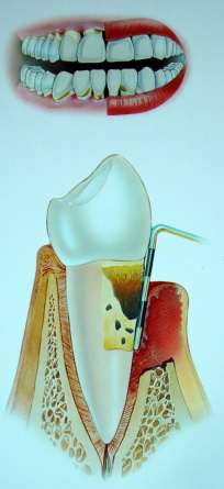 Die effektive Mundhygiene - Folgen mangelnder Mundhygiene