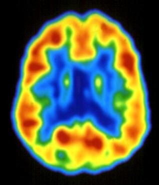 Demenzerkrankungen Gesund Alzheimer Demenz Frontale Demenz (Morbus Pick)