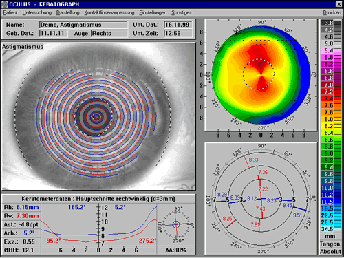 Orthokeratologie Korrigieren Sie Ihre Kurzsichtigkeit im Schlaf mit Ortho-K-Linsen!