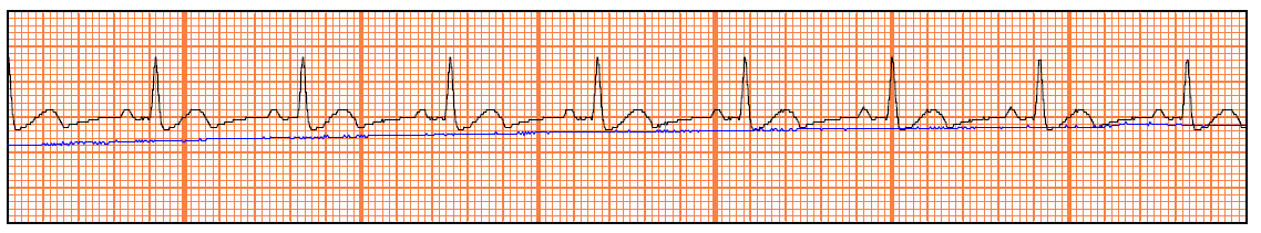 Defiköln - AED Während eines Einsatzes wird das abgeleitete EKG aufgezeichnet und