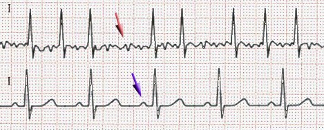 Anwendung: Erkennung von Herzvorhofflimmern Vorhofflimmern zeichnet sich besonders dadurch aus, dass die P-Wellen, die sonst im EKG erkennbar sind, fehlen.