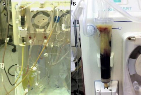 Recurrent Clotting of Dialysis Filter Associated With Hypertriglyceridemia Induced by Propofol Bassi E. et al.