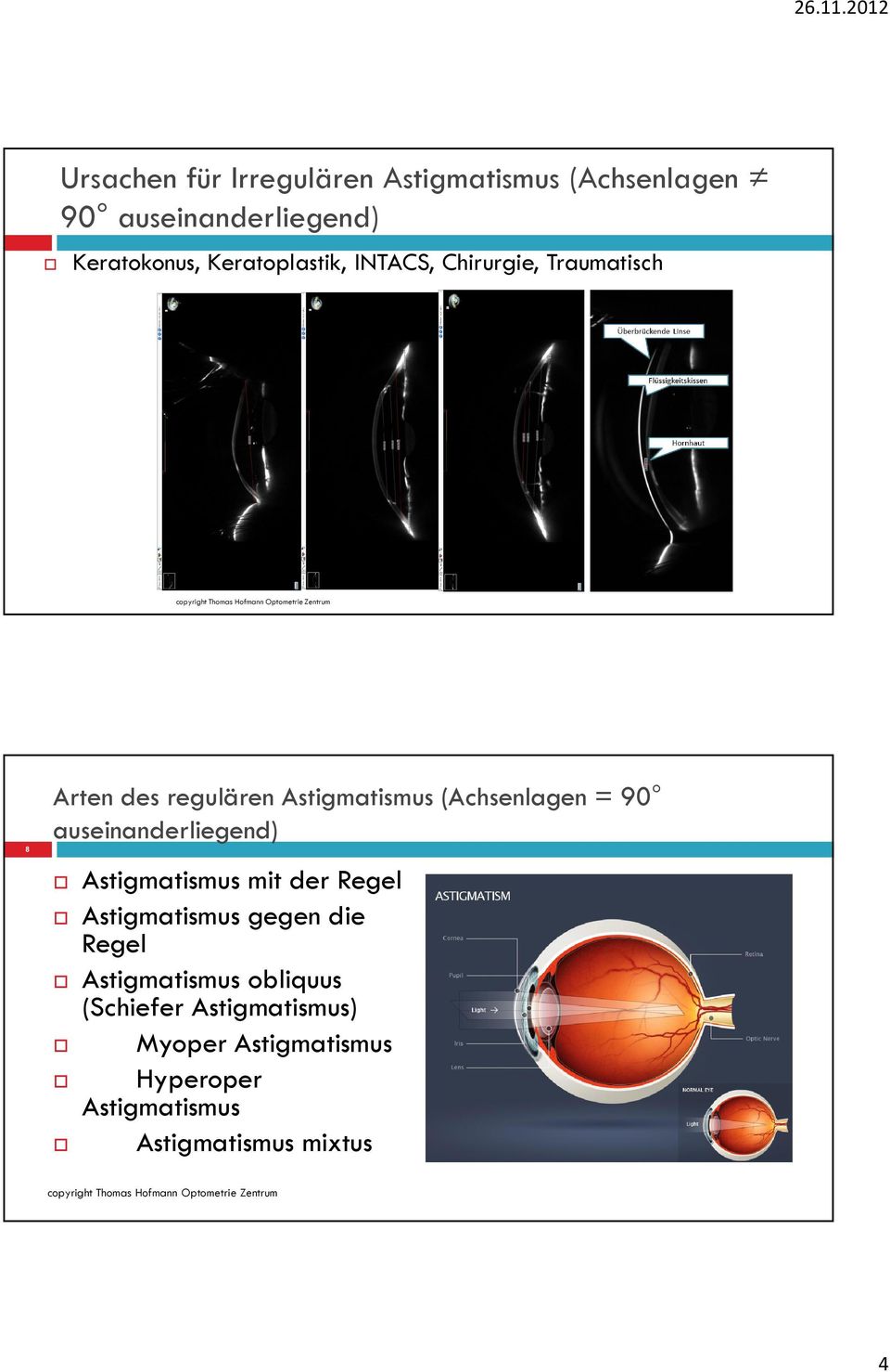 (Achsenlagen = 90 auseinanderliegend) Astigmatismus mit der Regel Astigmatismus gegen die Regel