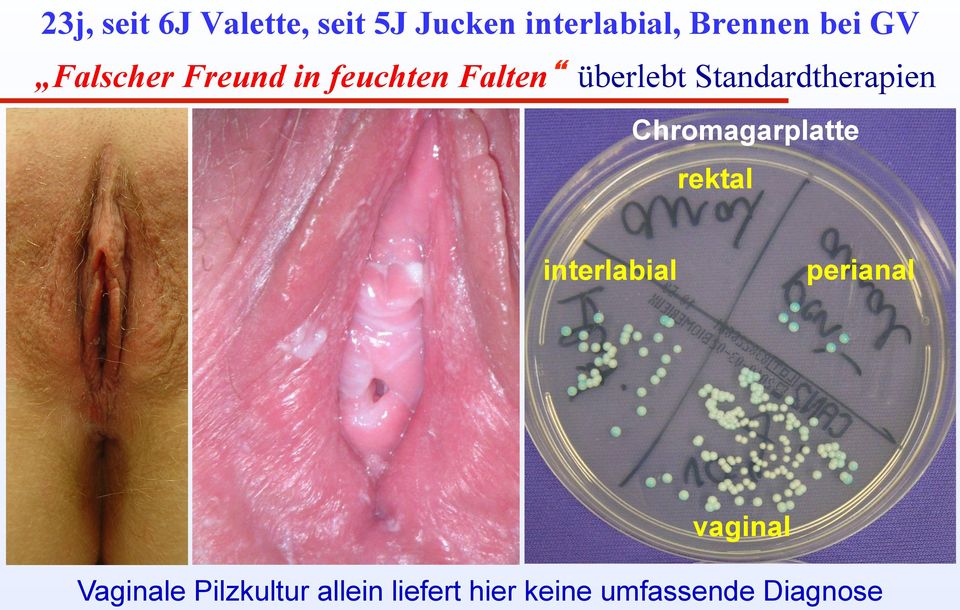 Standardtherapien Chromagarplatte rektal perianal