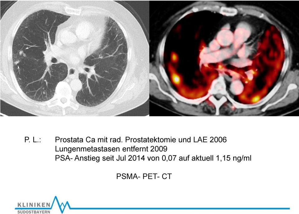 Lungenmetastasen entfernt 2009 PSA-