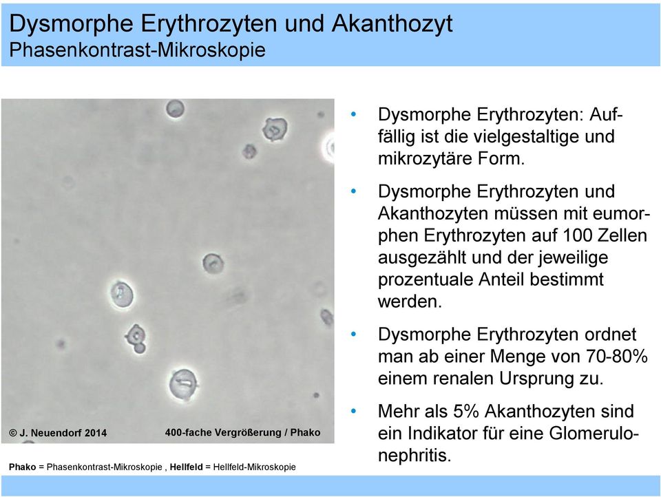 Dysmorphe Erythrozyten und Akanthozyten müssen mit eumorphen Erythrozyten auf 100 Zellen ausgezählt und der