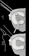 Liegt der Riss also nah an der Meniskus- Basis, so kann er genäht werden. Das Bild unten zeigt wie ein solcher Meniskusriss über Hohlkanülen genäht werden kann. (Outside-in-Technik, Bilder 1 und 2).