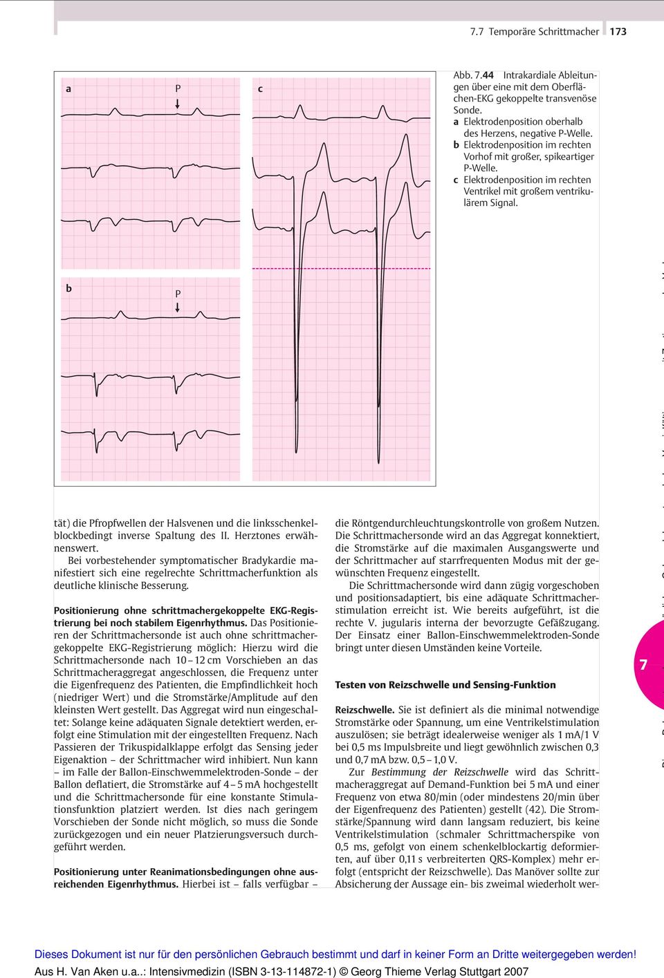 b P tät) die Pfropfwellen der Halsvenen und die linksschenkelblockbedingt inverse Spaltung des II. Herztones erwähnenswert.