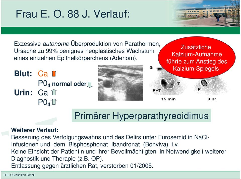 Blut: Ca P0 4 normal oder Urin: Ca P0 4 Weiterer Verlauf: Besserung des Verfolgungswahns und des Delirs unter Furosemid in NaCl- Infusionen und dem