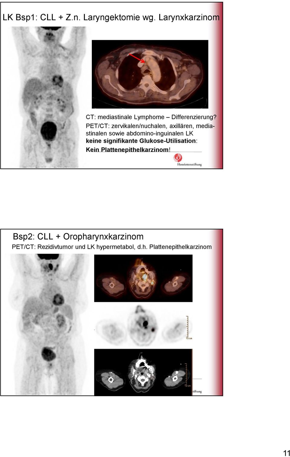 PET/CT: zervikalen/nuchalen, axillären, mediastinalen sowie abdomino-inguinalen LK