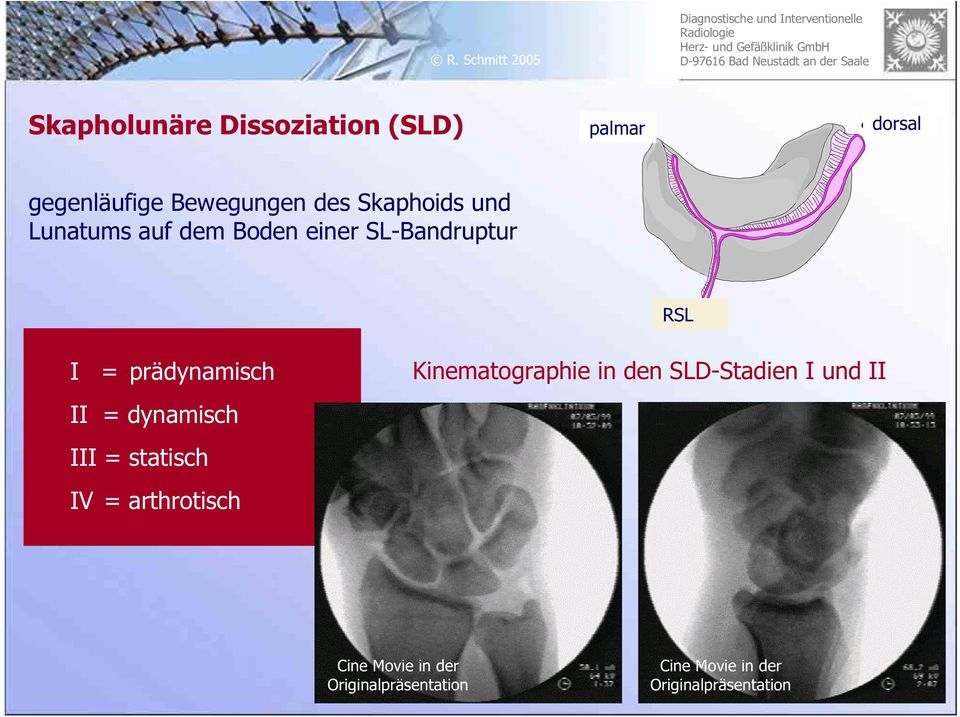 II = dynamisch III = statisch IV = arthrotisch Kinematographie in den