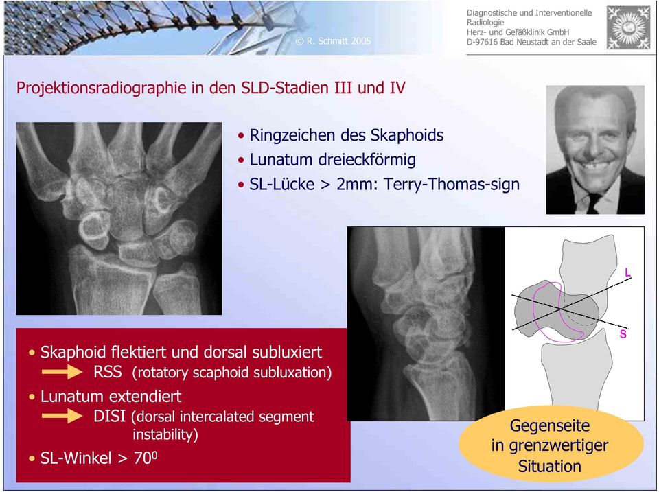 dorsal subluxiert RSS (rotatory scaphoid subluxation) Lunatum extendiert DISI