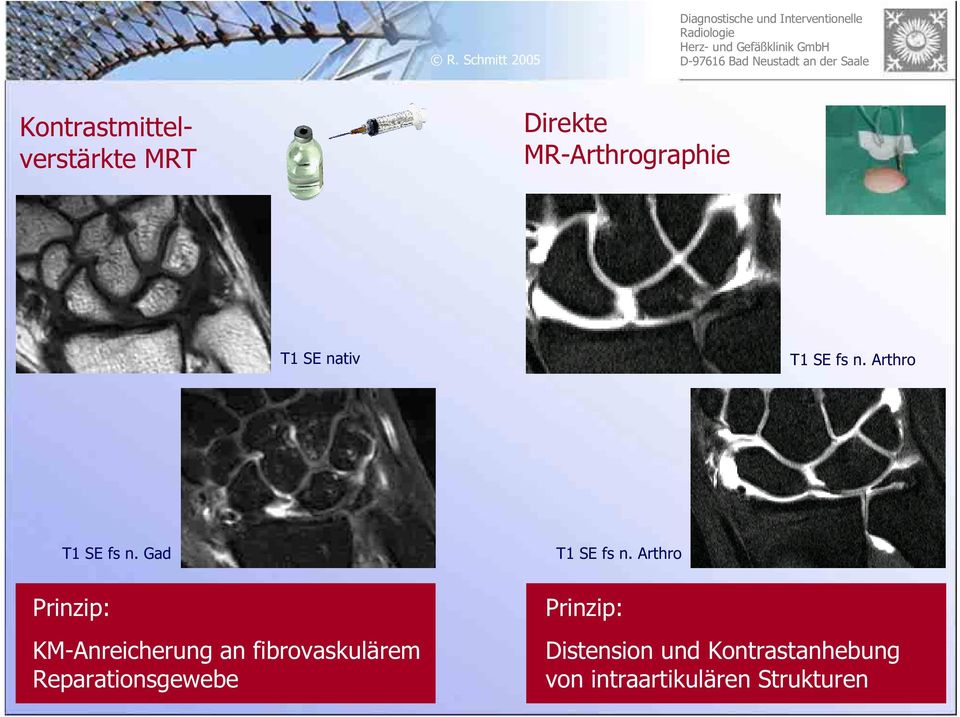 Arthro Prinzip: KM-Anreicherung an fibrovaskulärem