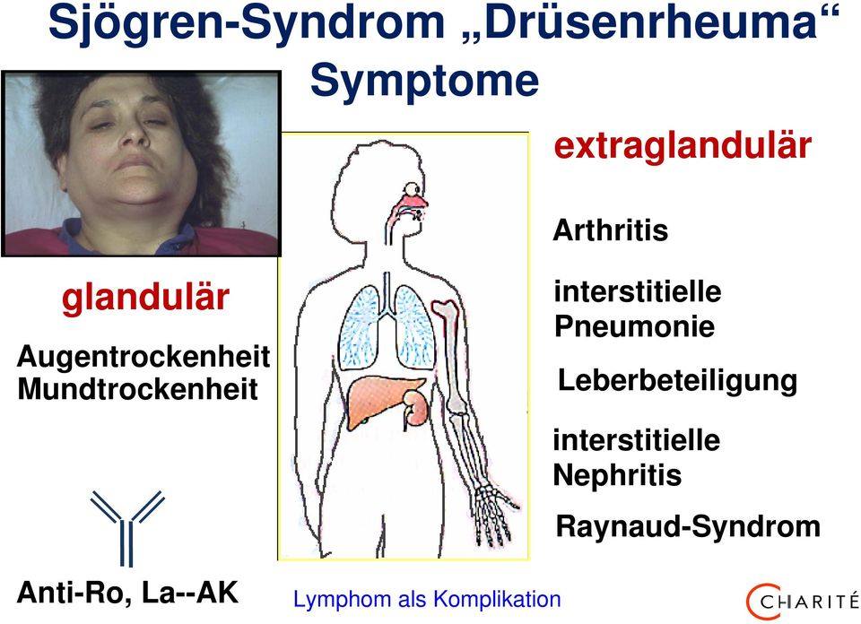Mundtrockenheit Anti-Ro, La--AK Lymphom als Komplikation