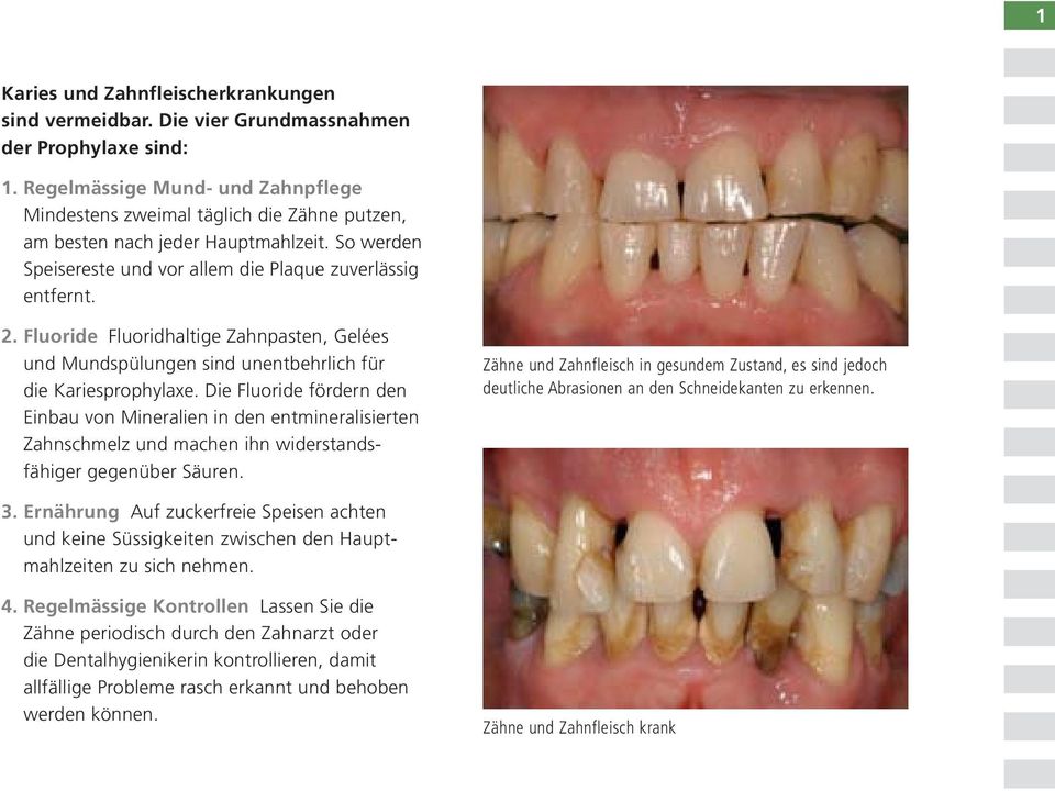 Fluoride Fluoridhaltige Zahnpasten, Gelées und Mundspülungen sind unentbehrlich für die Kariesprophylaxe.