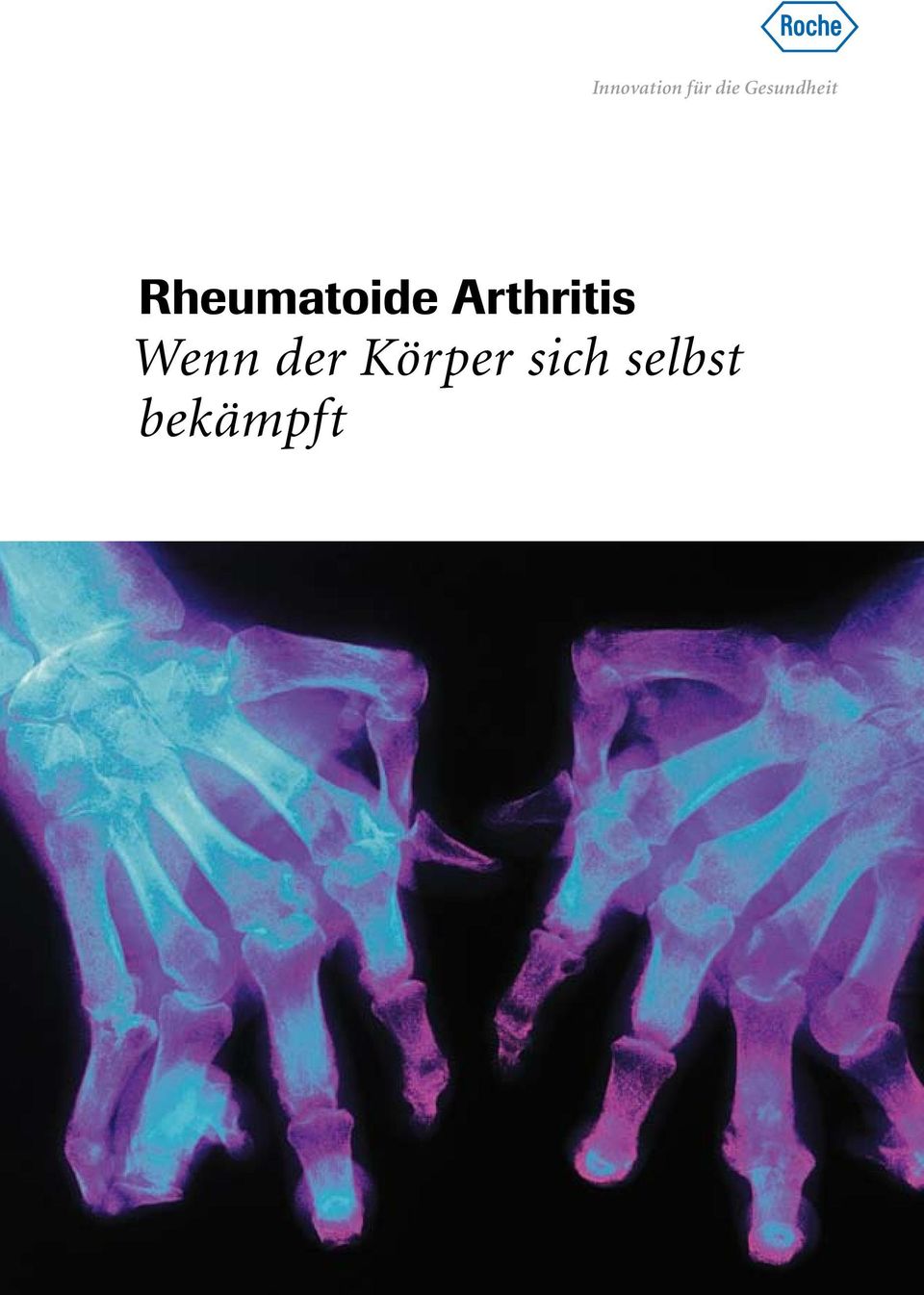 Rheumatoide Arthritis